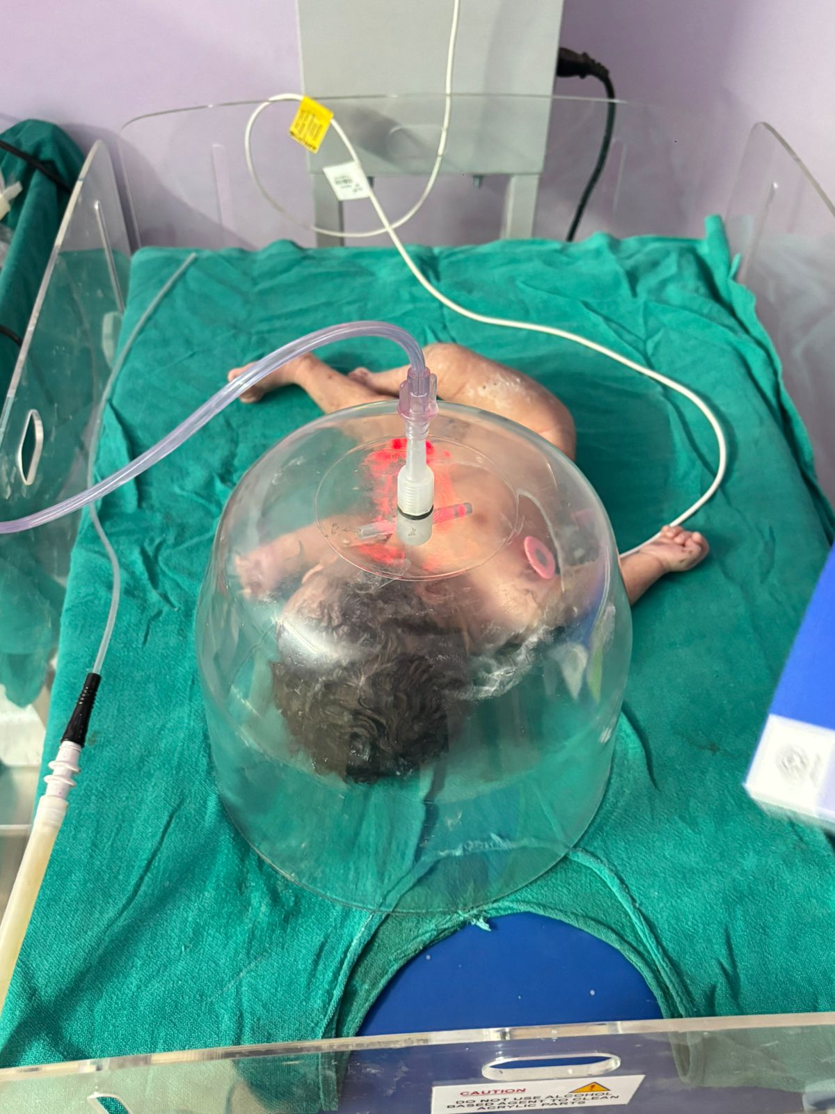 Newborn baby receiving NICU care at Gyandeep Hospital